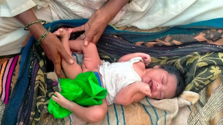 Baby Born With 3 Legs,