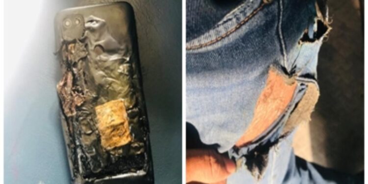 Again Mobile Blast: The mobile kept in the pocket of the pants suddenly exploded… badly burnt thigh