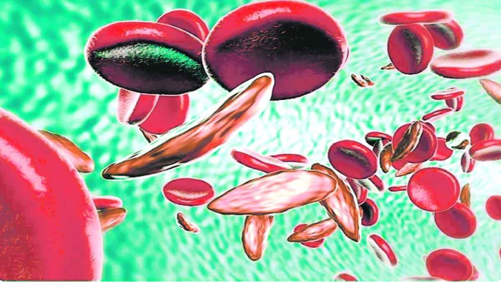 Eradication of sickle cell will mark developed India