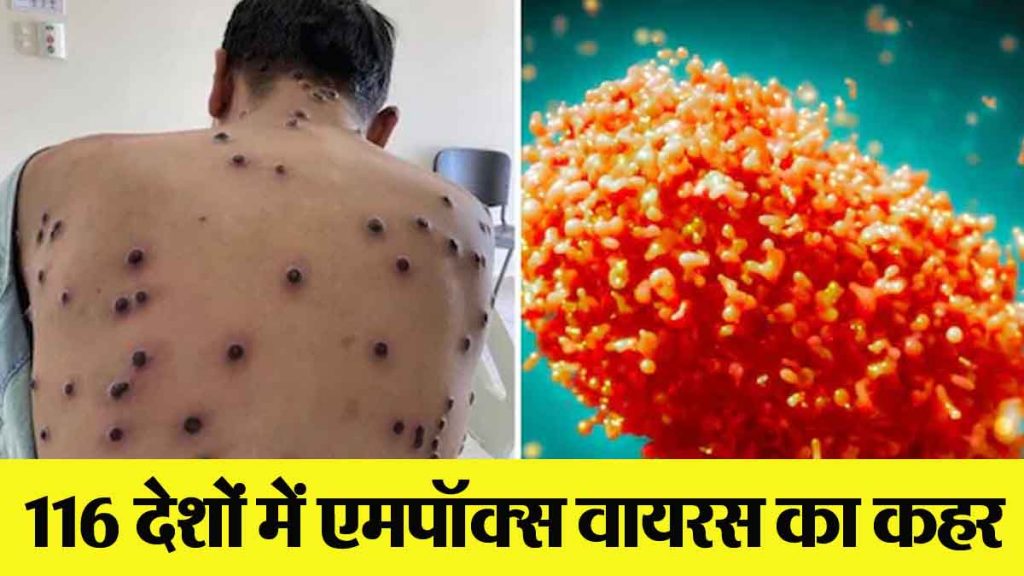 Mpox Virus: Mpox virus is wreaking havoc in 116 countries of the world; Know, what are the conditions and symptoms in India?