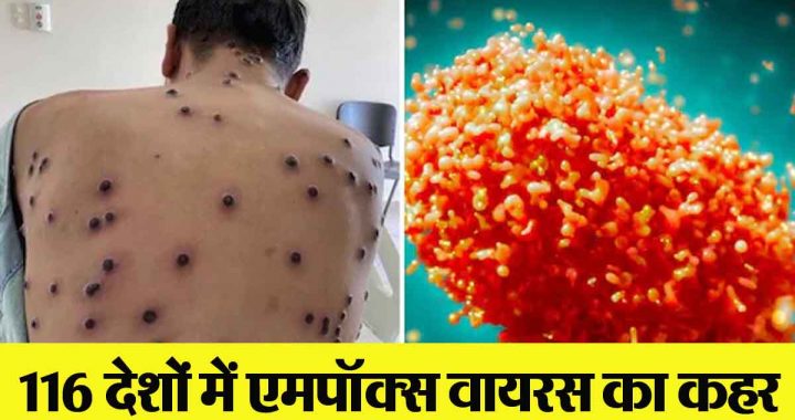 Mpox Virus: Mpox virus is wreaking havoc in 116 countries of the world; Know, what are the conditions and symptoms in India?