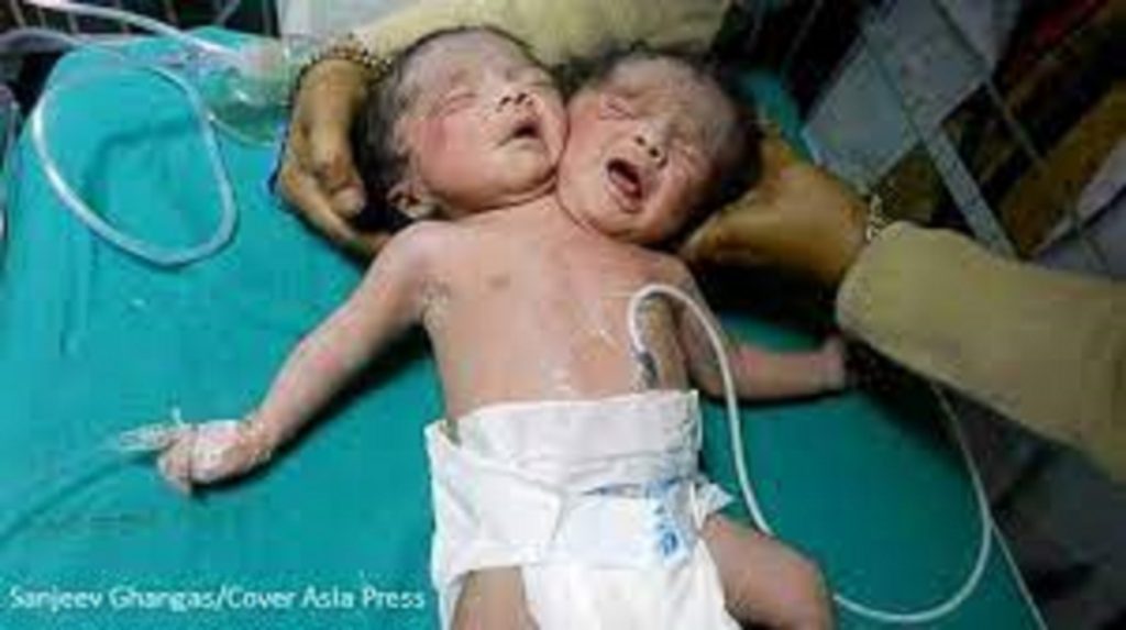 Two Headed Baby Born India