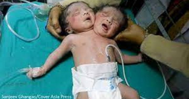 Two Headed Baby Born India