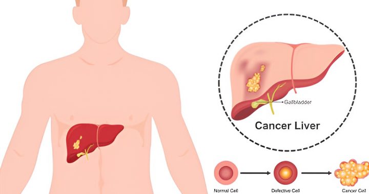 Liver Cirrhosis Treatment