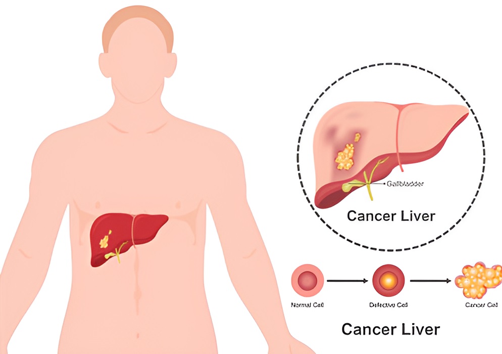 Liver Cirrhosis Treatment