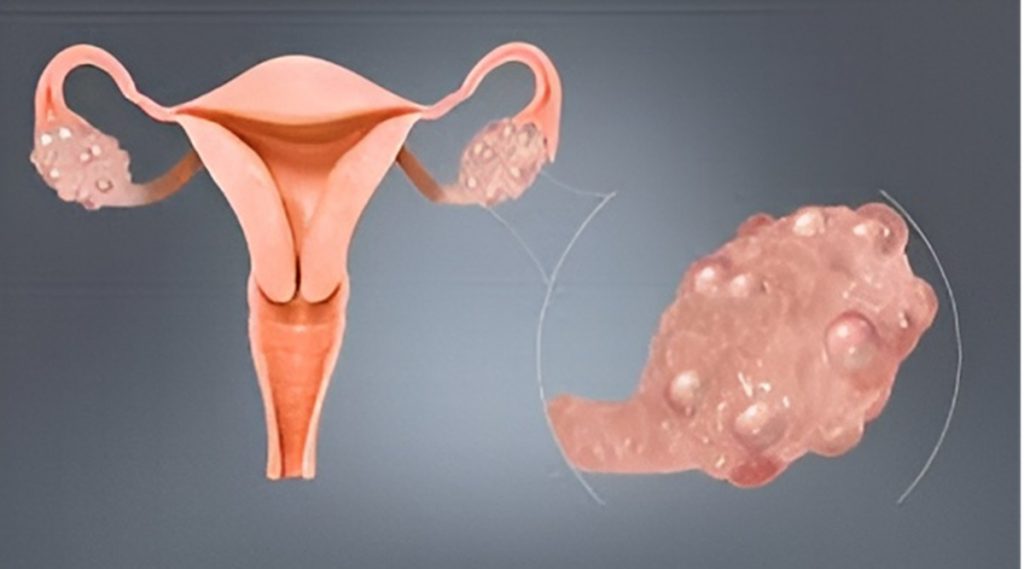 PCOS Causes