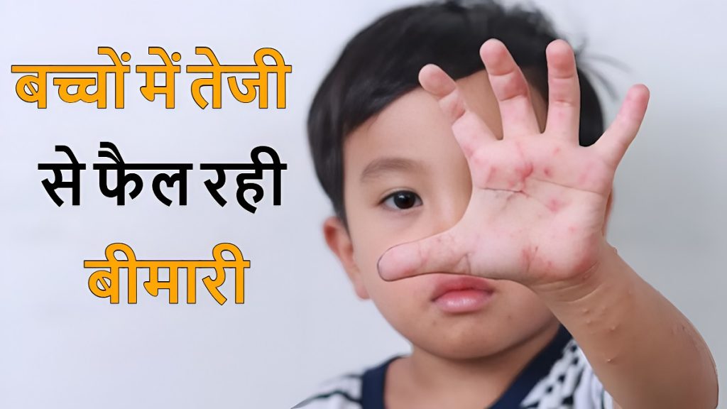 Hand Foot Mouth Disease