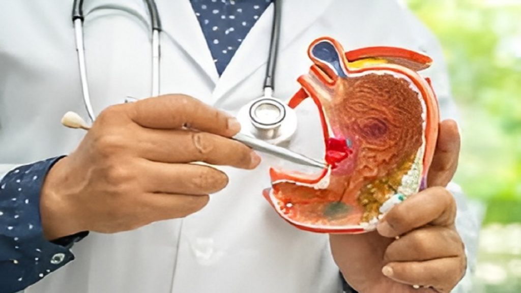 Stomach Cancer Symptoms