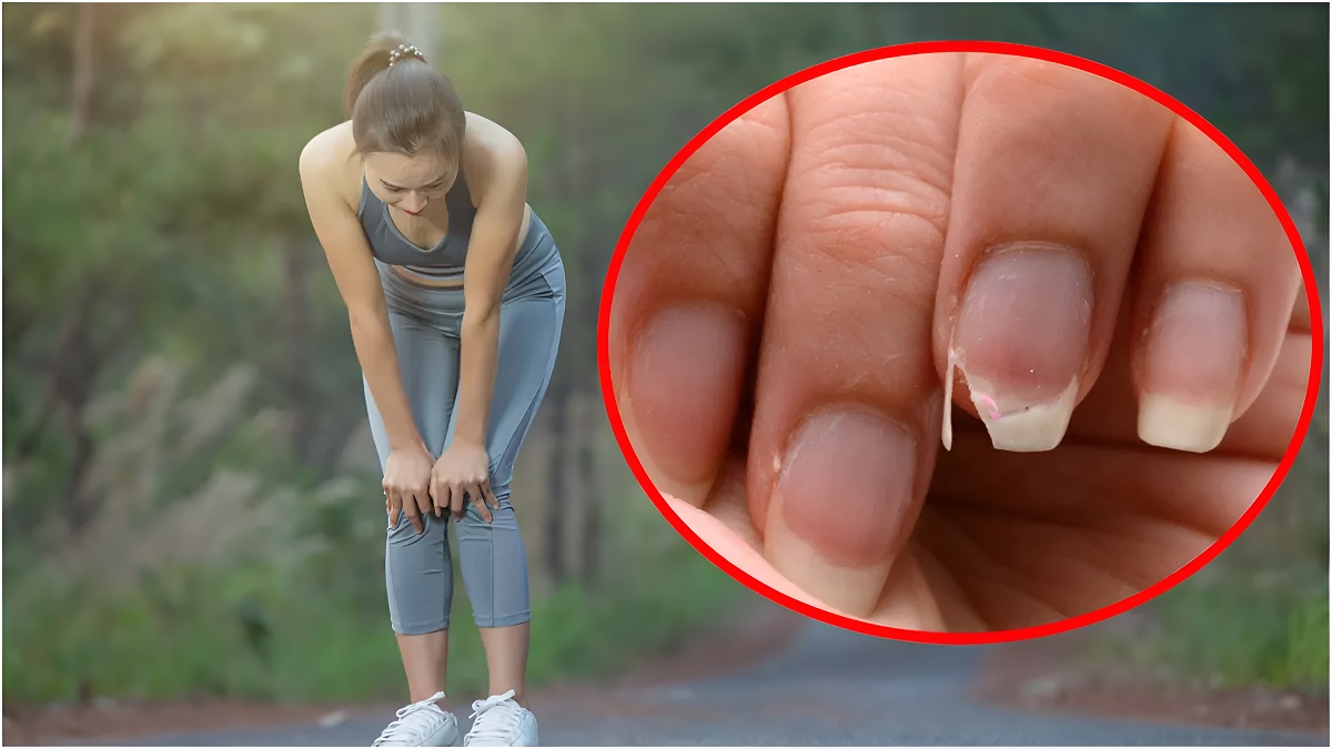 Vitamin Deficiency Symptoms