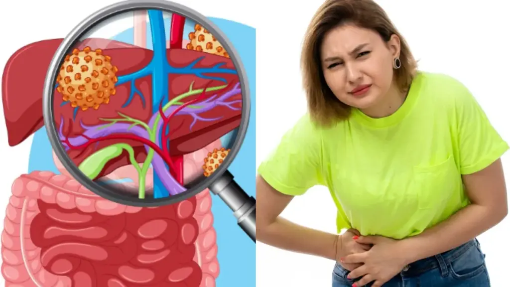 Fatty Liver Symptoms