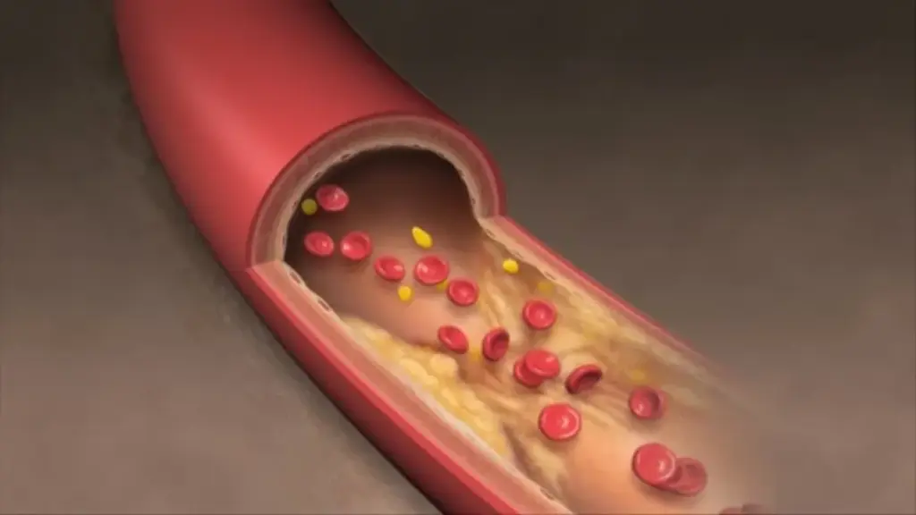 High Cholesterol Causes