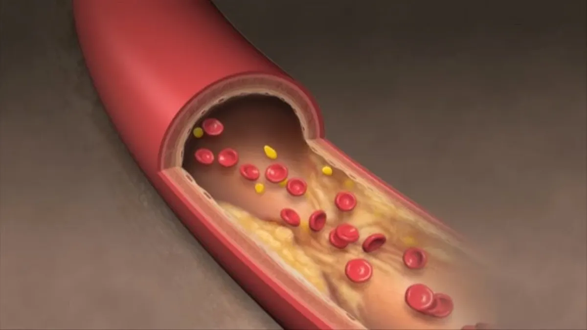 High Cholesterol Causes